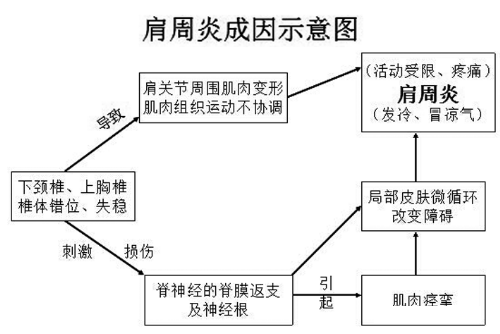 肩周炎的症状及如何改善