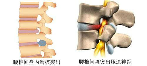 腰椎间盘突出应挂什么科