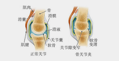 骨关节炎